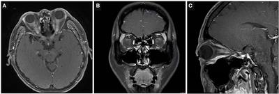 Differences in Neuropathic Pain and Radiological Features Between AQP4-ON, MOG-ON, and IDON